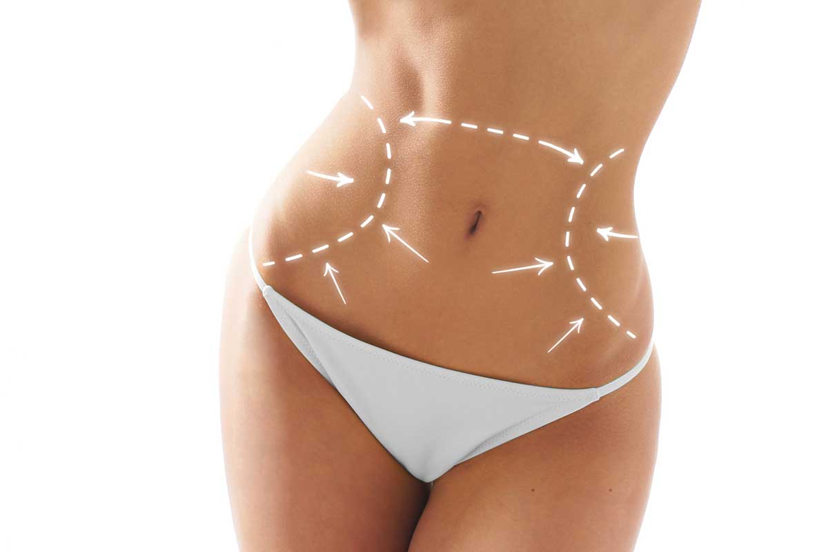 Diferencias entre la liposucción, lipoescultura y abdominoplastia